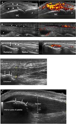 Ultrasound Imaging in Psoriatic Arthritis: What Have We Learnt in the Last Five Years?